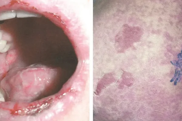 Test De Alergia De: Moxifloxacino-TLH