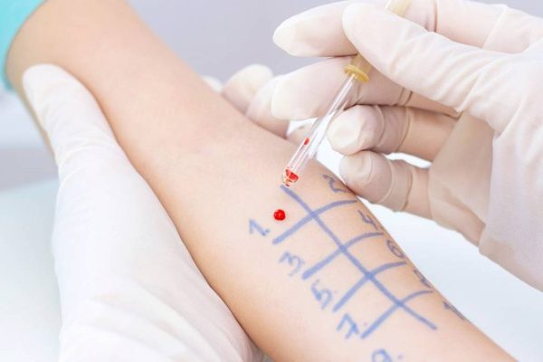 Test De Alergia De: Carbamacepina-RAST